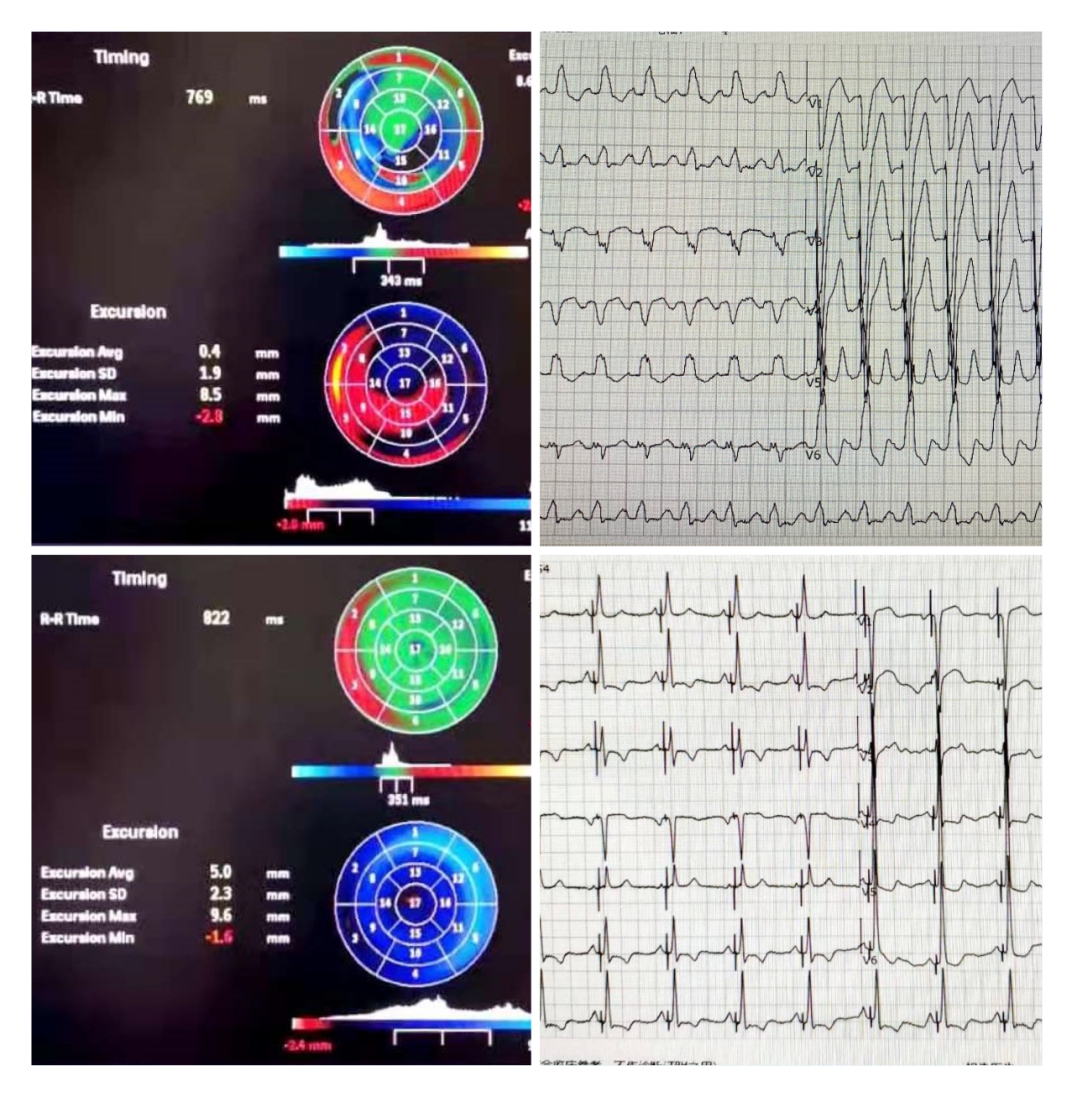 1574740203971098974.jpg 牛眼图心电图-拼图(1).jpg